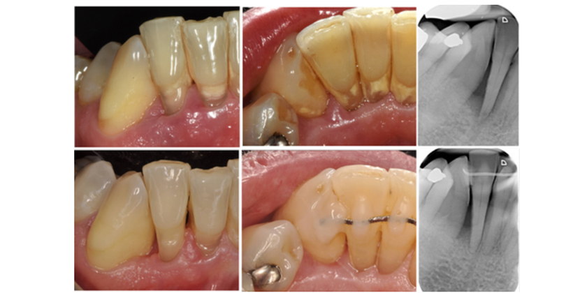 Treating Intrabony Defects