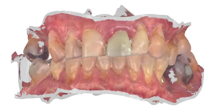 Digital Workflow: Dental Implant Case Study