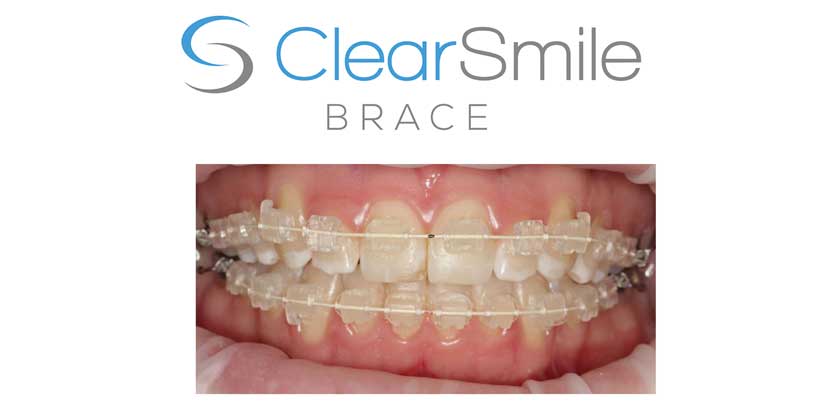 clearsmile braces